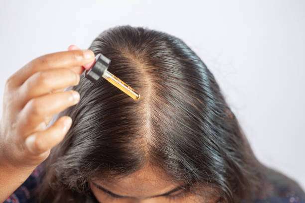hair oil, girl, balding head, minoxidil, dropper